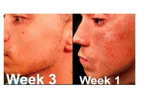 Complete Acne System